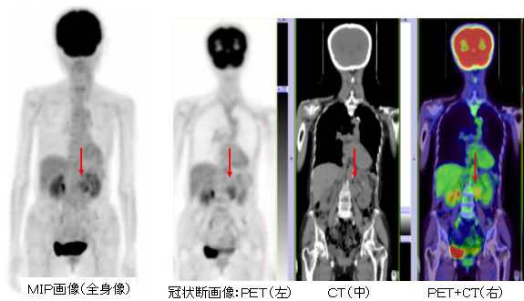 FDG-PET/CT:褐色細胞腫再発（同一患者）