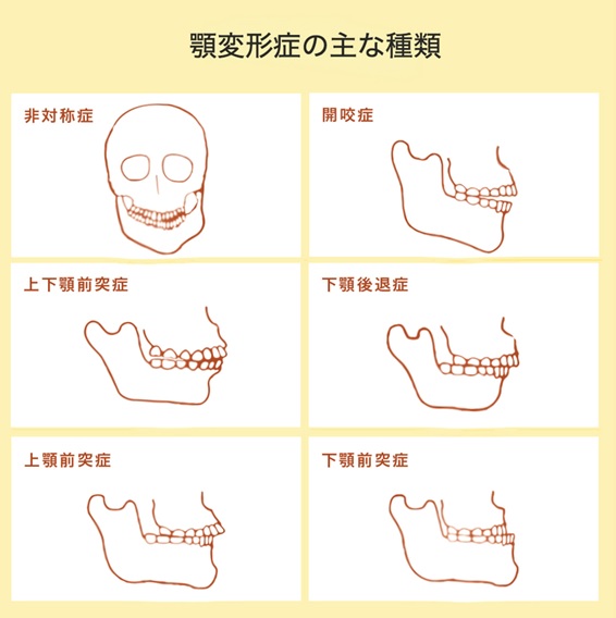 顎変形症の主な種類