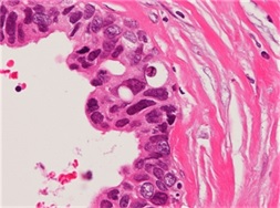 乳癌のヘマトキシリン・エオジン染色(×40)