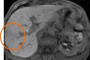 肝腫瘍外科的切除適応症例における慢性肝機能障害時の3次元的肝機能予測とその臨床応用に関する研究