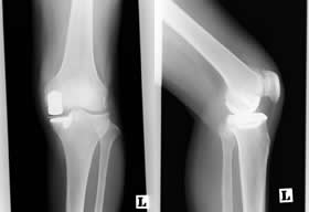 人工膝関節単顆置換術について
