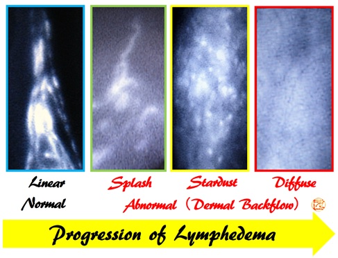 Lymph flow evaluation using ICG lymphography