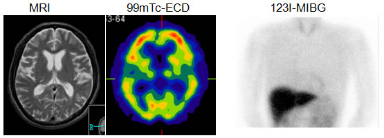 脳血流シンチグラフィーとMIBGシンチグラフィーによるレビー小体型認知症（DLB）の診断例