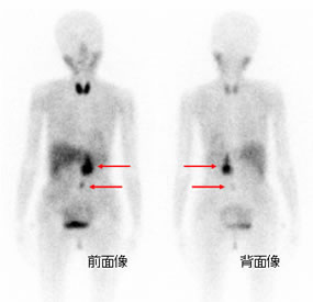 副腎髄質シンチグラフィー：123I-MIBG：褐色細胞腫再発