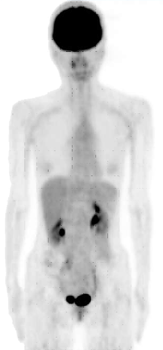 FDG-PETの正常全身画像（図1）。