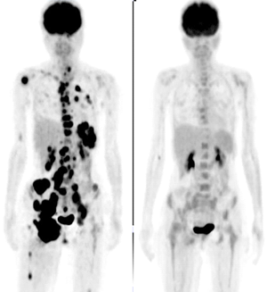悪性リンパ腫の患者様の治療前、後のFDG-PET画像（図9）