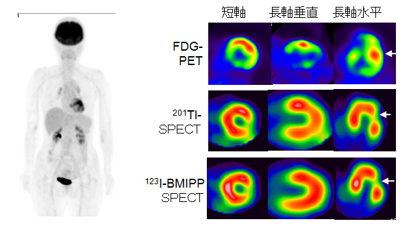 左MIP画像、右FDGPETの3軸断層画像と、タリウム・脂肪酸のSPECT像。